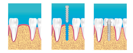 Implants dentaires La clusaz